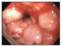 Cancer of distal duodenum: Whipple's procedure Cancer of distal duodenum: Whipple's procedure