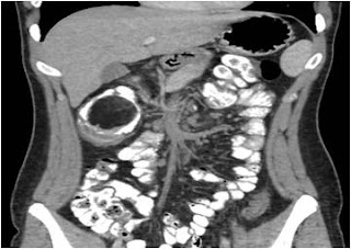 Lipoma ascending colon